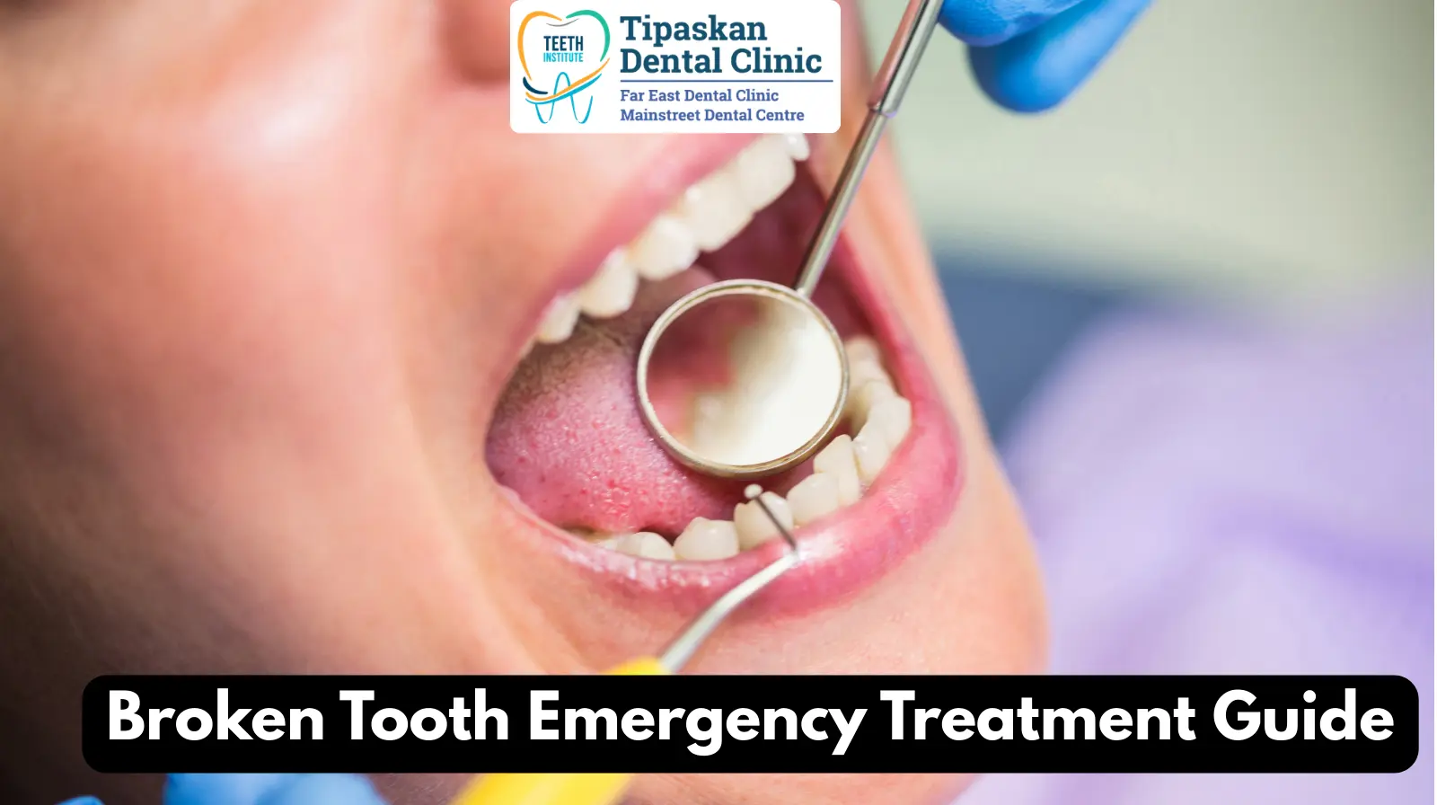 Broken Tooth Emergency Treatment Guide