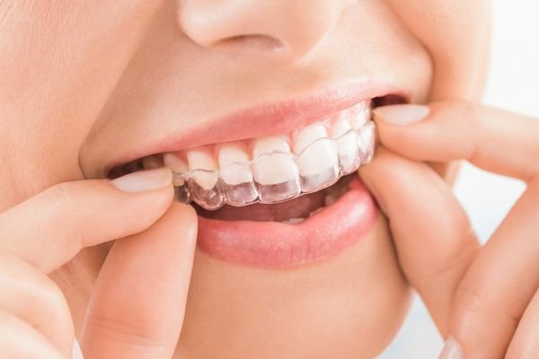 Invisalign Edmonton